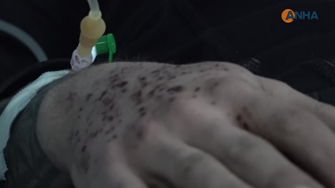 ⁣وصول 35 جريحاً وجريحة من أهالي الشيخ مقصود والأشرفية إلى الحسكة